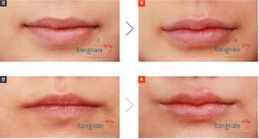 Hiệu quả thu mỏng môi tại BVTM Kangnam