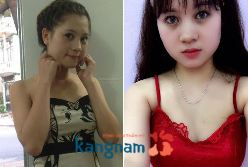 Hình ảnh so sánh trước và sau khi tạo môi trái tim tại Kangnam1