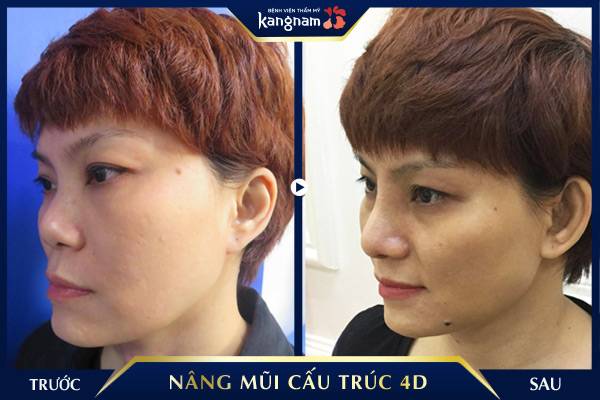 nâng mũi cấu trúc 4d kangnam Tanggiap TangGiap Net