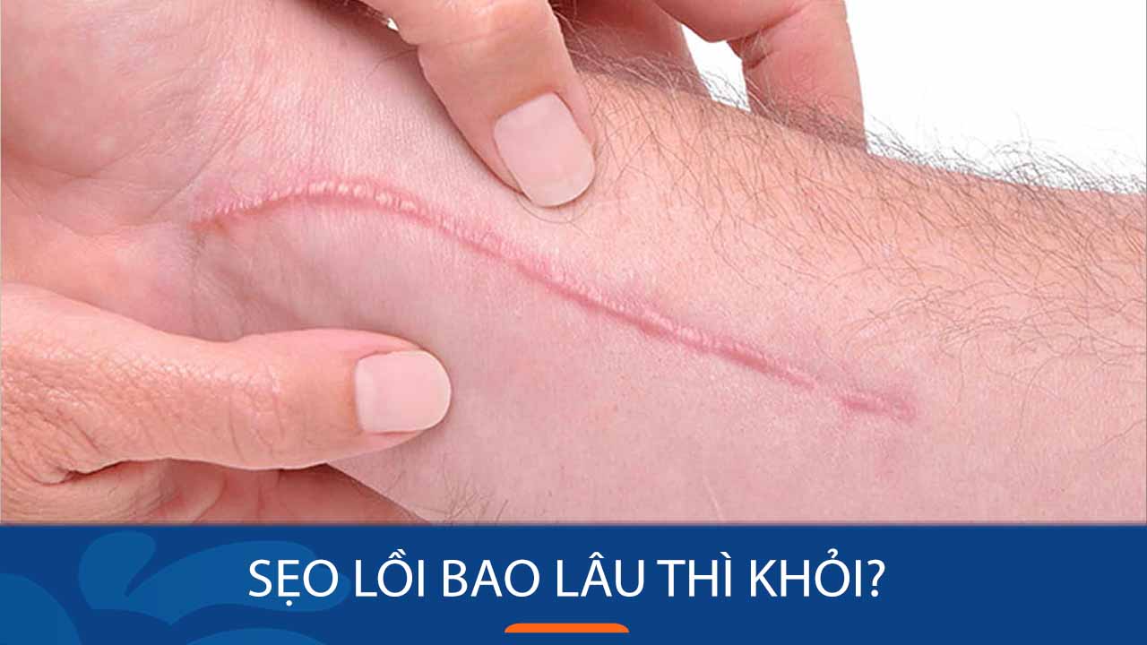 Sẹo lồi bao lâu thì khỏi Giải đáp thắc mắc từ chuyên gia da liễu