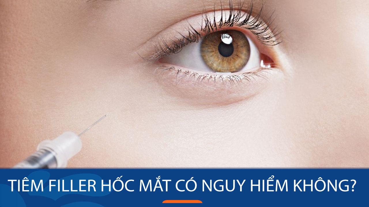 Tiêm filler hốc mắt có nguy hiểm không Giải đáp mọi thắc mắc