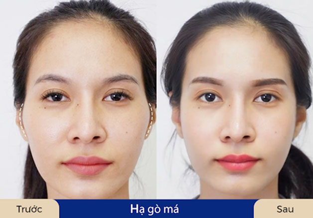 Xương gò má cao, gương mặt già nua nên cân nhắc hạ gò má