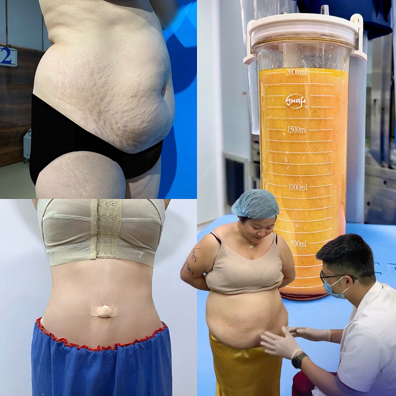 Công nghệ hút mỡ càng hiện đại sẽ mang lại hiệu quả càng cao