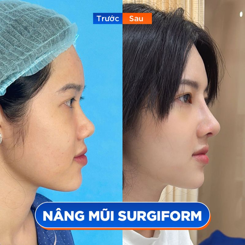 Dáng mũi cao thanh tú chuẩn tỉ lệ vàng sau nâng mũi 6D