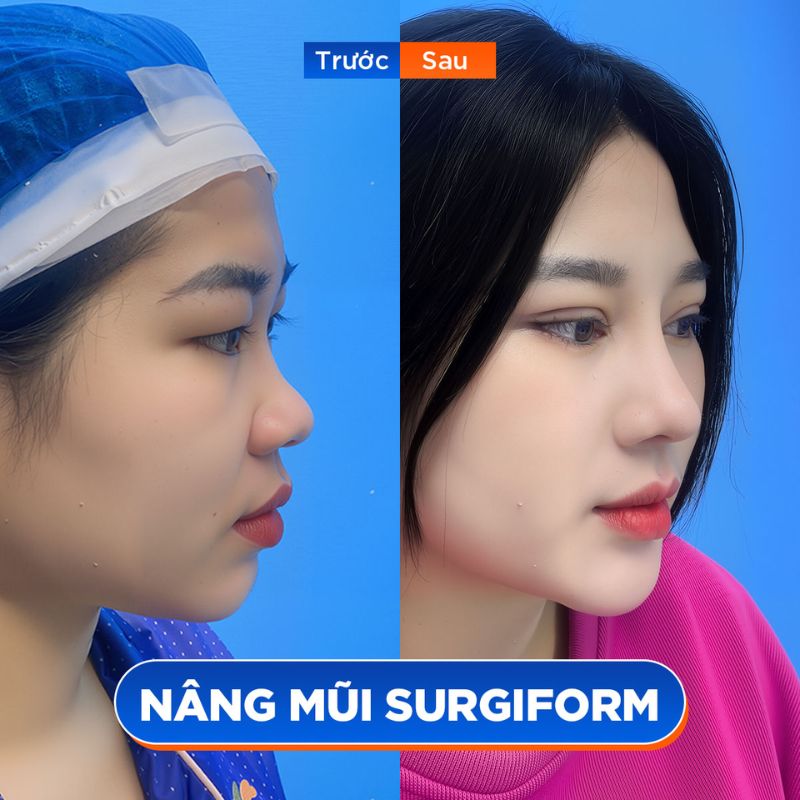 Biến đổi ngoạn mục với công nghệ nâng mũi 6D không đau tại Kangnam