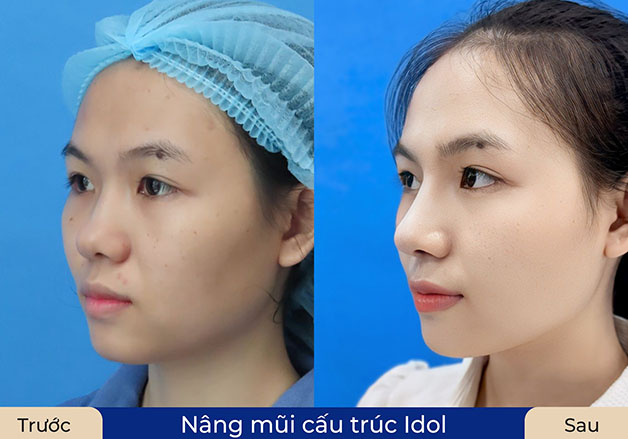 Góc nghiêng hoàn hảo với đường sống mũi mềm mại, tự nhiên