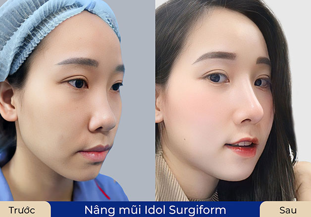 Dáng mũi cao thon tự nhiên sau khi nâng mũi cấu trúc Idol