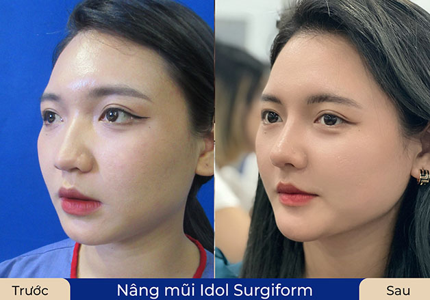 Kỹ thuật dựng trụ mũi bằng sụn tự thân giúp đầu mũi chắc khỏe