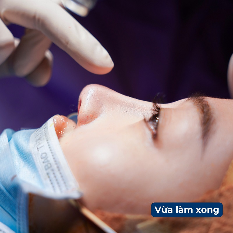 Dáng mũi nhanh hồi phục, đẹp tự nhiên