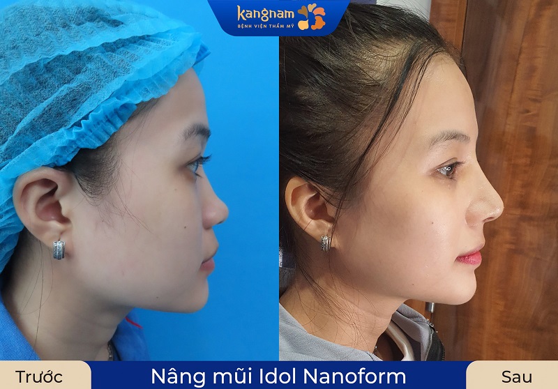 Nâng mũi Idol kiến tạo dáng mũi đẹp chuẩn sao Hàn