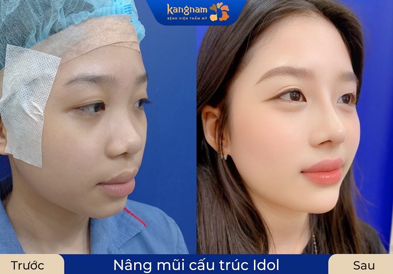 Khuôn mặt khách hàng tươi sáng, cân đối và đẹp hơn sau nâng mũi