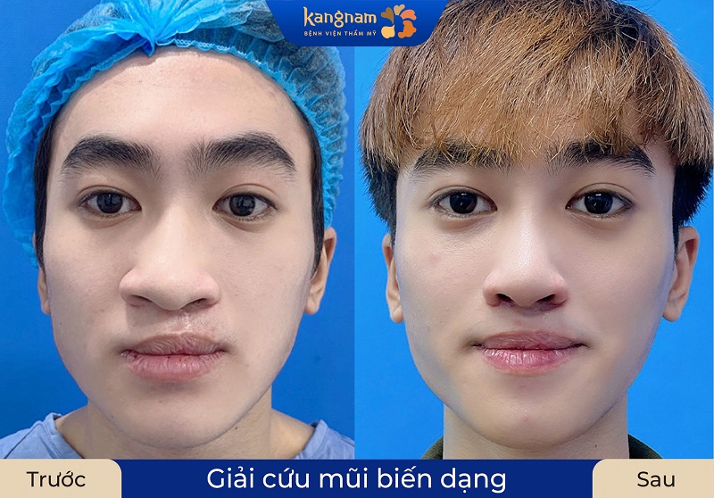Sửa lại mũi hỏng cho khách hàng lấy lại vẻ ngoài tự nhiên, hoàn hảo hơn