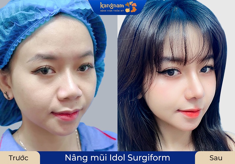 Khách hàng sở hữu dáng mũi cao, hài hòa với khuôn mặt