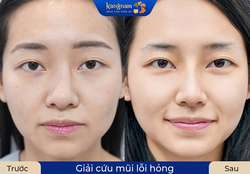 Sửa mũi nhanh chóng, an toàn và không lộ sóng