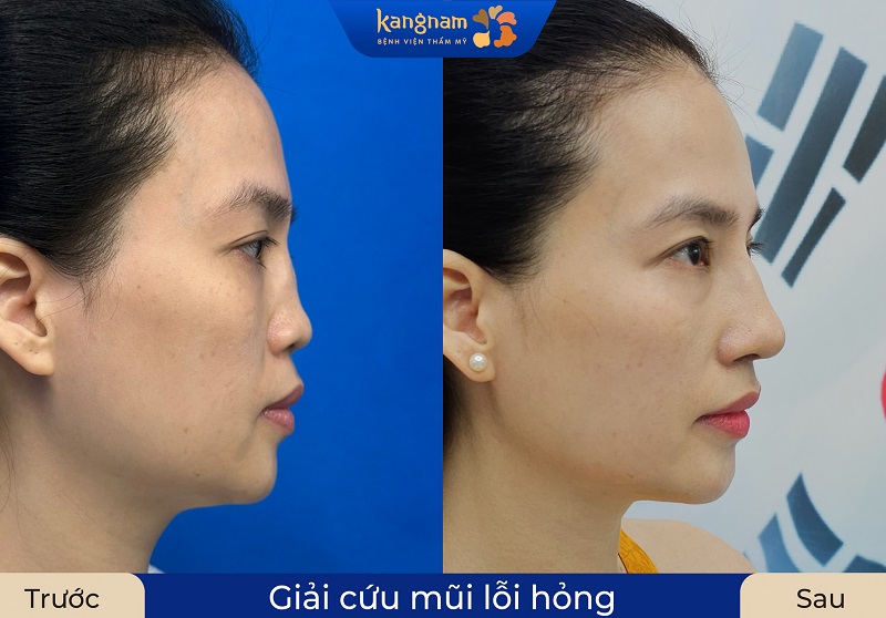 Khách hàng trước và sau khi chỉnh sửa lại dáng mũi tại Kangnam