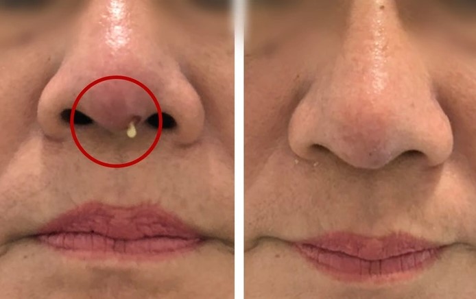 Tháo sụn mũi do biến chứng sau nâng mũi
