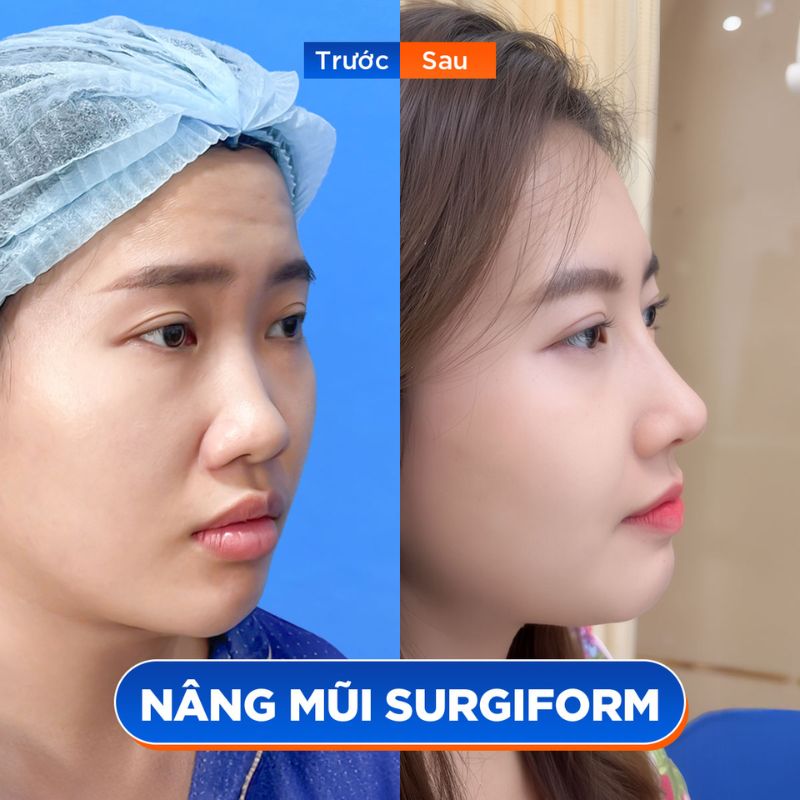 Khắc phục hoàn toàn sống mũi thấp, mũi to bè