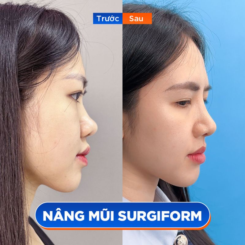 Người có mũi thấp tẹt