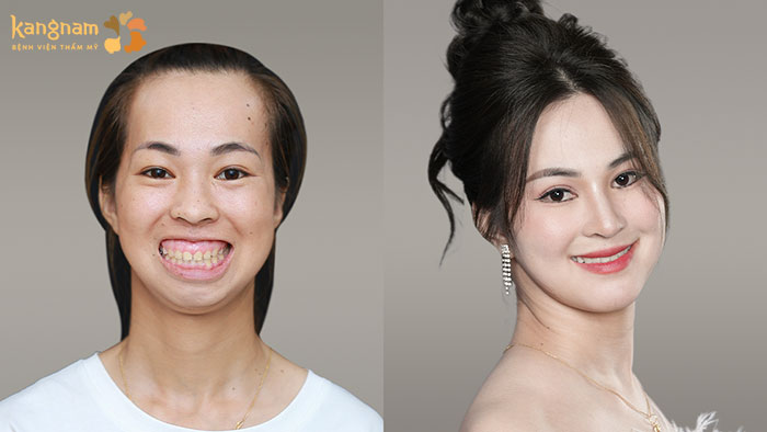 Thí sinh Nguyễn Kim Phượng (Mùa 6) đã có gương mặt cân đối, hài hòa hơn