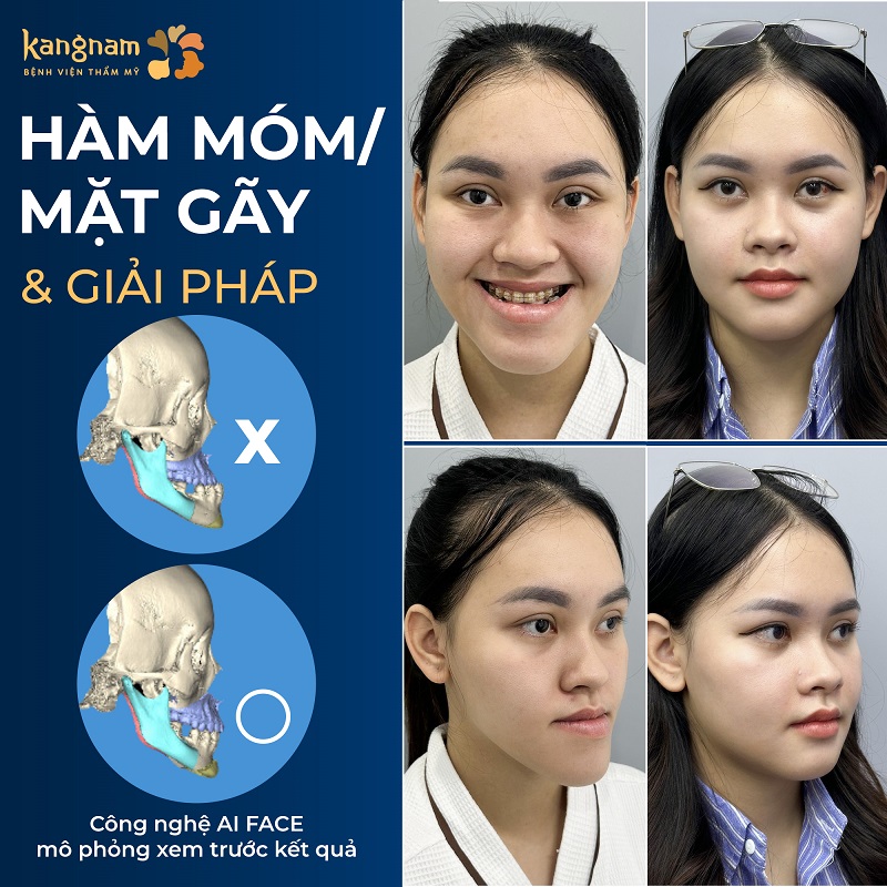 Ứng dụng công nghệ AI FACE mô phỏng xem trước kết quả