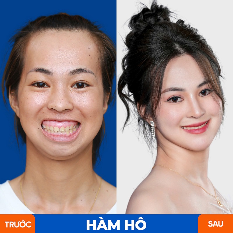 Phẫu thuật Hàm hô không để lại sẹo