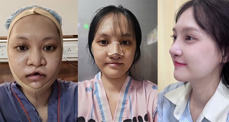 Phẫu thuật thời điểm vàng mang lại kết quả tối ưu hơn