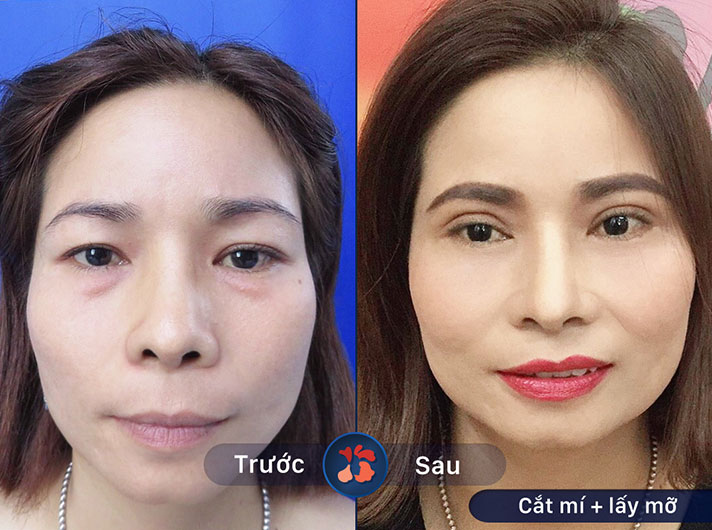 Ms.Thanh - Quy trình thực hiện cắt mí rất chuyên nghiệp, tôi hài lòng với kết quả cuối cùng