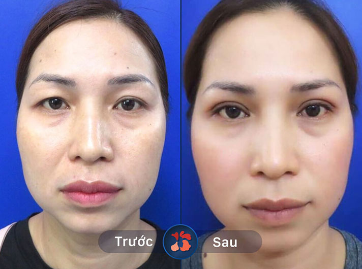 Ms.Lan Anh - Khách hàng cảm thấy rất tự tin với đôi mắt to tròn, to đẹp sau khi cắt mí tại Kangnam