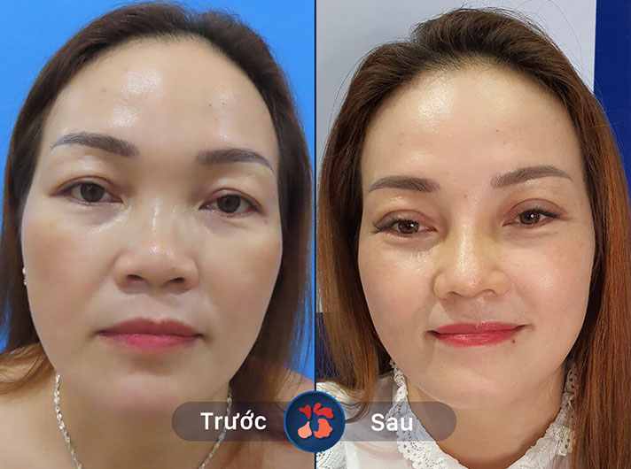 Ms.Thu Hương - Tôi rất hài lòng với kết quả cắt mí tại đây. Đôi mắt tôi trở nên đẹp và tươi trẻ hơn rất nhiều
