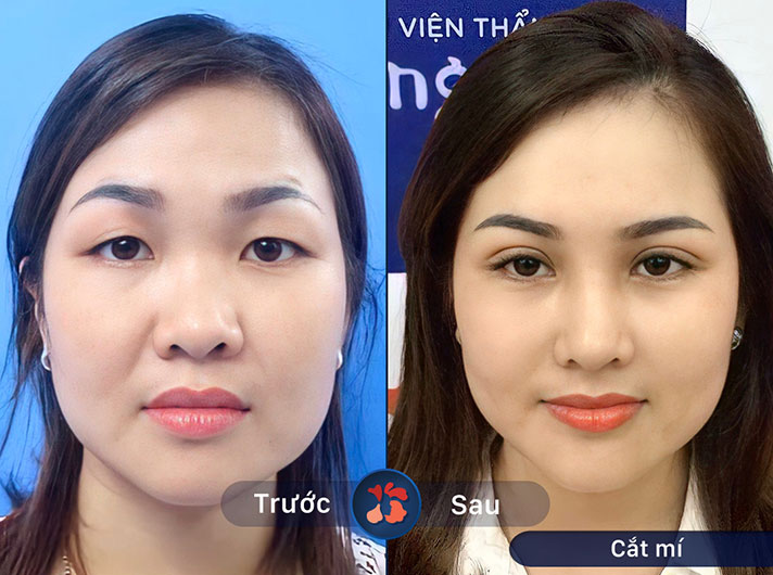Ms.Thanh Hằng - Trải qua dịch vụ cắt mí, chị Hằng trông trẻ ra nhiều tuổi và tự tin hơn trong giao tiếp