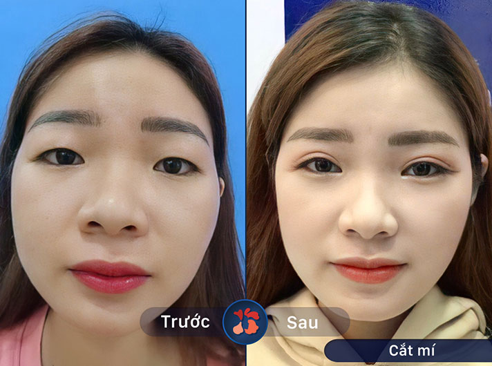 Ms.Thu Hiền - Kết quả sau cắt mí thật tuyệt vời, mắt chị Hiền trông rất tươi trẻ và sắc nét