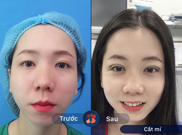 Ms.Lan - Quy trình cắt mí được thực hiện rất khoa học, an toàn và hiệu quả