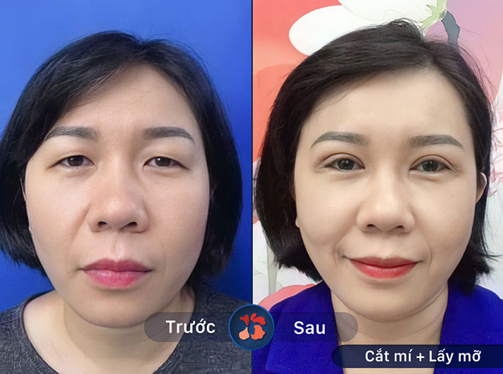 Ms.Bích Trâm - Đôi mắt trở nên tươi tắn và rạng rỡ hơn rất nhiều