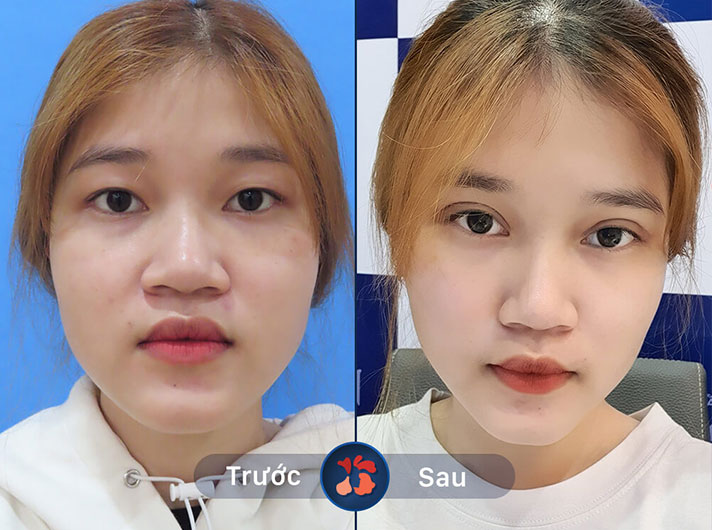 Ms.Thanh - Đã tìm hiểu rất nhiều nơi trước khi lựa chọn địa chỉ cắt mí này và thật sự không hề thất vọng về dịch vụ