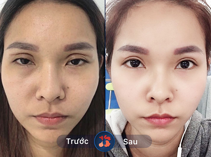 Ms.Bích Ngân - Rất hài lòng vì đôi mắt của bản thân trở nên to tròn, long lanh hơn rất nhiều