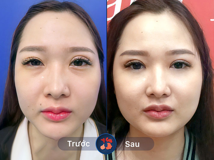 Ms.Hạnh - Đôi mắt mới đã giúp chị Hạnh cải thiện rất nhiều vẻ ngoài và tự tin hơn trong công việc cũng như cuộc sống