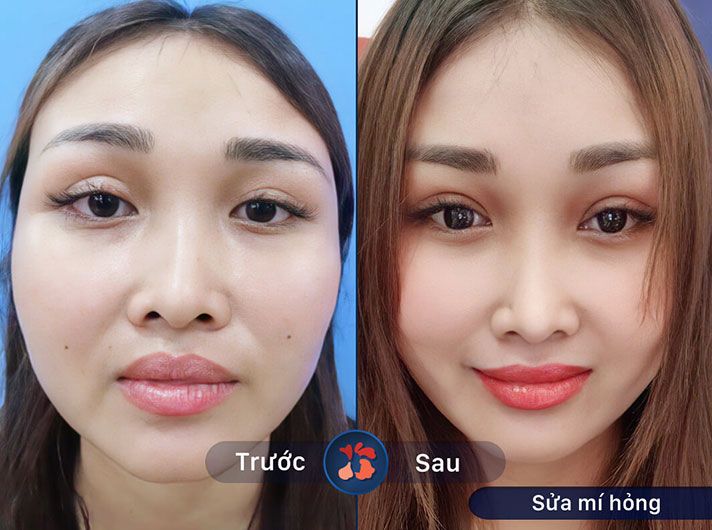 Ms.Hồng - Kết quả vượt quá mong đợi của chị Hồng, đôi mắt trông rất tự nhiên và hấp dẫn
