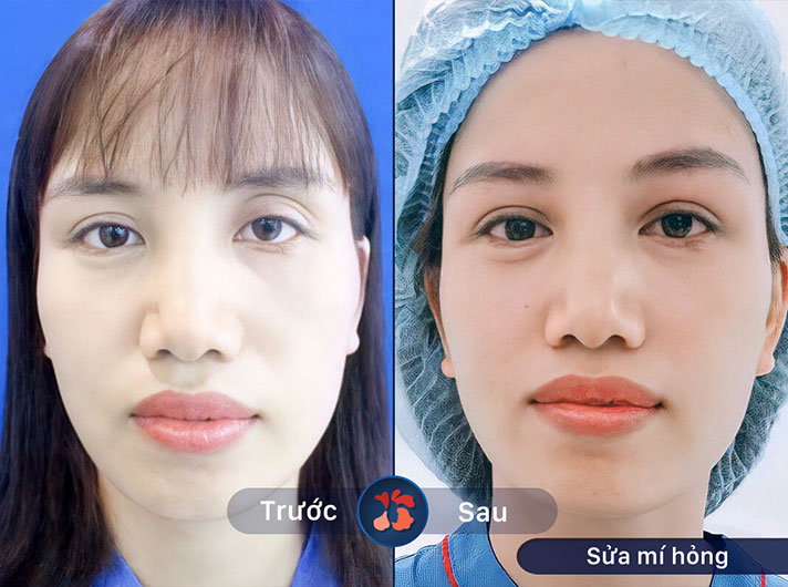 Ms.Nga - Khách hàng ngạc nhiên vì gương mặt mình trở nên trẻ trung và tươi tắn hơn rất nhiều
