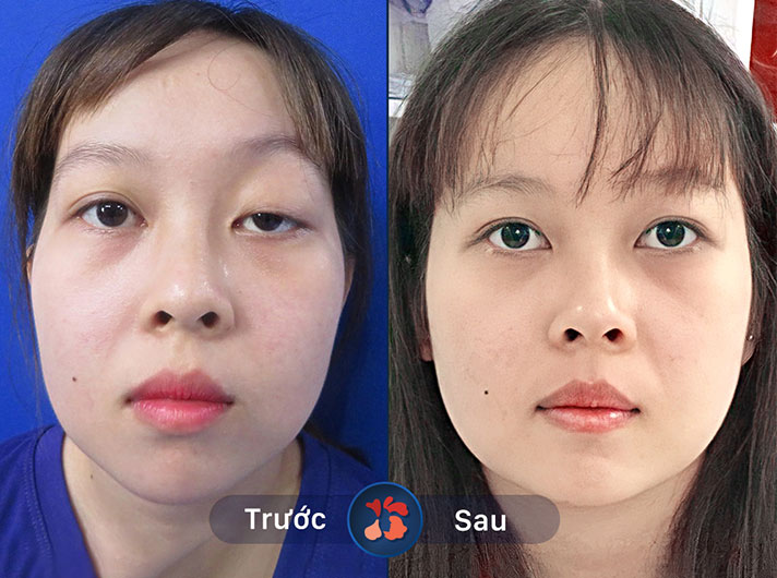 Ms.Hương Ly - Sau khi cắt mí, đôi mắt tôi trở nên to tròn và đầy sức sống hơn