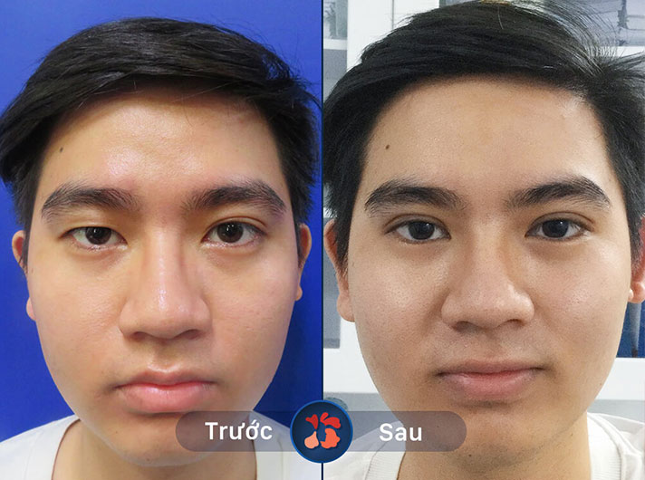 Mr.Trung - Đôi mắt to tròn và tươi tắn hơn nhiều