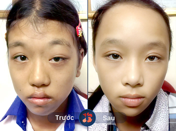 Ms.Liên - Đôi mắt mới đã giúp anh Tuấn cải thiện rất nhiều vẻ ngoài