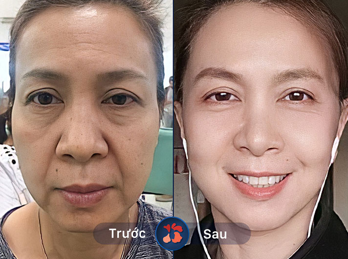 Ms.Mai - Chị Mai rất hài lòng với kết quả nâng cung mày tại đây. Chân mày thon gọn, đẹp tự nhiên hơn hẳn trước đây
