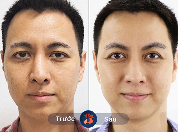Mr.Linh - Với đôi mày đẹp tự nhiên sau khi nâng cung, anh Linh cảm thấy tự tin hơn rất nhiều