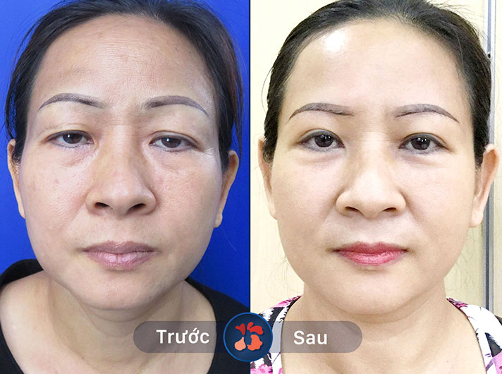 Ms.Giang - Dịch vụ nâng cung mày khiến khuôn mặt chị Giang trở nên sắc nét và thanh thoát hơn rất nhiều