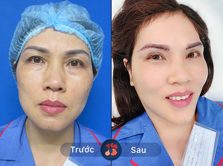 Ms.Hạnh - Đôi mày cong đều, hài hòa với khuôn mặt khiến chị Hạnh vô cùng yêu thích kết quả nâng cung mày tại đây