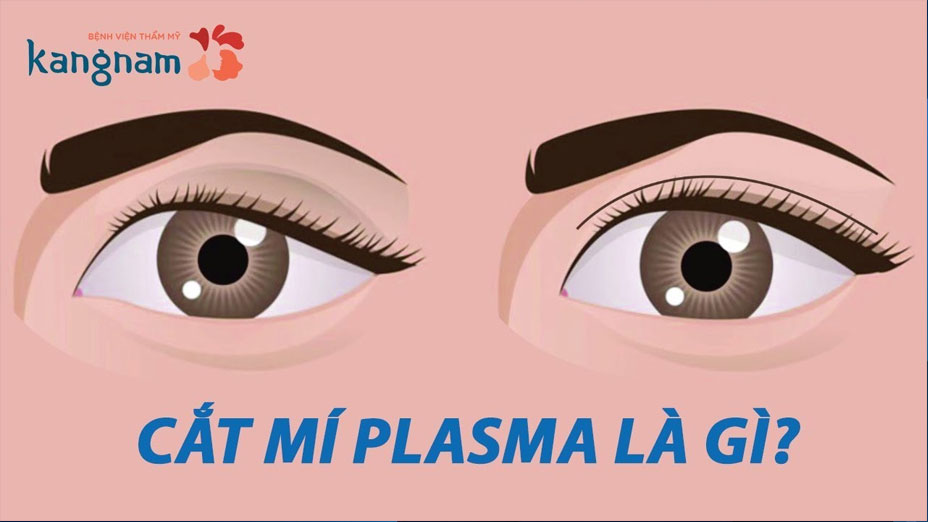 Cắt mí Plasma là gì?