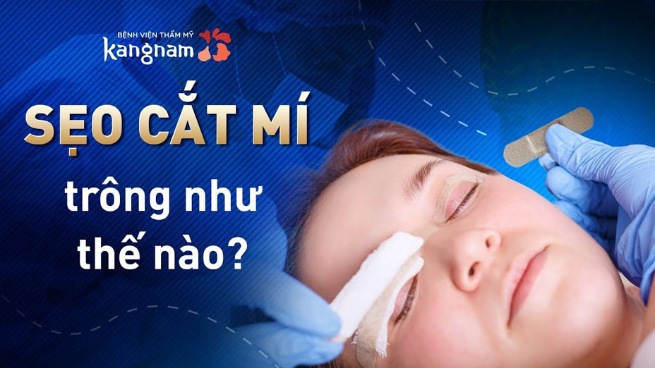 Sẹo cắt mí mắt trông như thế nào?