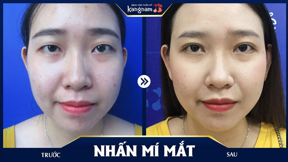 Nhấn mí sau 1 tháng đã tự nhiên chưa?