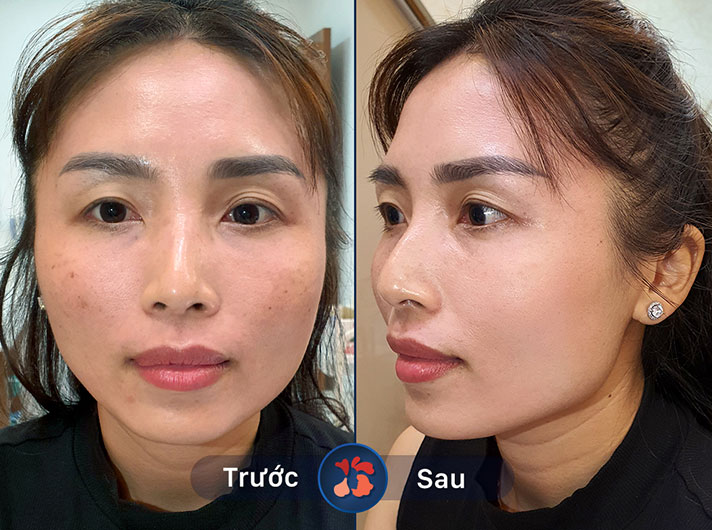 Ms.Thu Hằng - Chị Hằng rất hài lòng với kết quả điều trị nám. Da chị đã trở nên đều màu và tươi sáng hơn rất nhiều