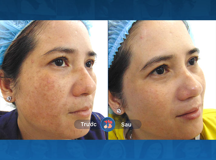 Ms.Hoa -  Những vết nám đã phai đi đáng kể. Khách hàng rất vui với kết quả này